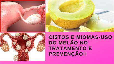 Cistos e Miomas Conheça o Método Saúde Feminina Link Abaixo do