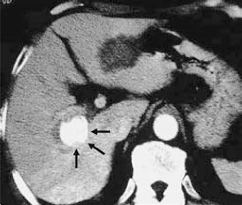 Figure From A Case Of Hepatic Infarction With Portal Venous Gas After