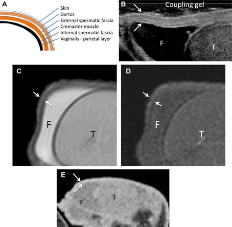 Scrotal Skin Lesions