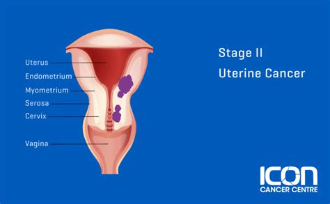 What Is Uterine Cancer Uterine Cancer Explained Icon Cancer Centre