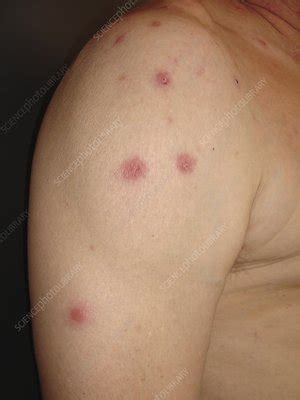 Neutrophilic Dermatosis In Sweet S Disease Stock Image C048 2937