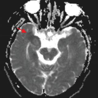 MRI Findings In A Patient With Herpes Simplex Virus Encephalitis A