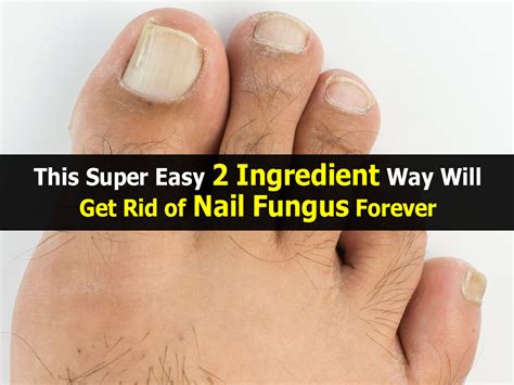 This Super Easy 2 Ingredient Way Will Get Rid Of Nail Fungus Forever