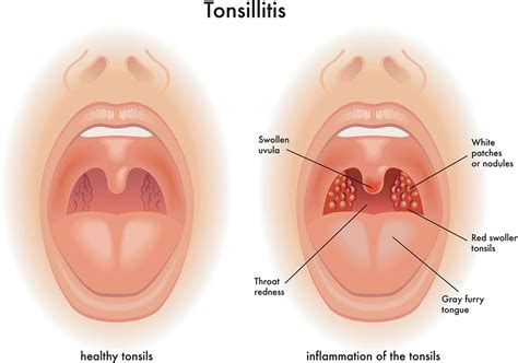 How To Deal With Tonsillitis - Sinkforce15