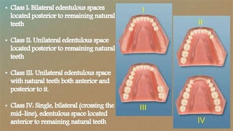 Classification Of Rpd Lecture