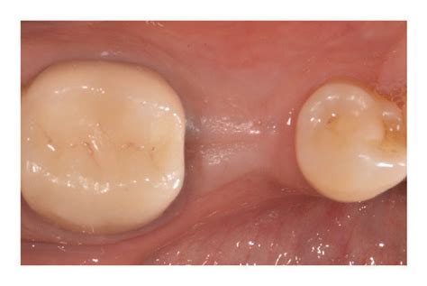 Immediate Implant Placement Of A Mandibular Second Premolar 45 Soft