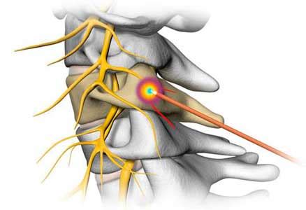 Radiofrecuencia Lumbar Precio Opiniones Y Efectos Secundarios