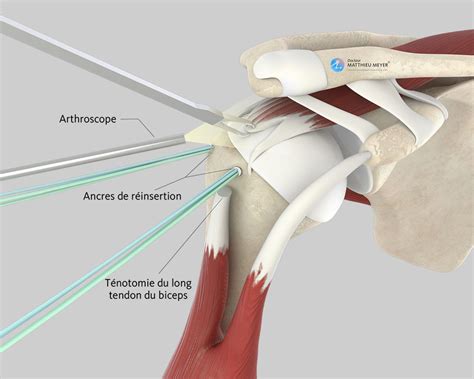 Réparation de la coiffe des rotateurs par arthroscopie Docteur