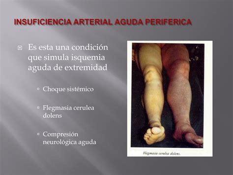 Ppt Insuficiencia Arterial Periferica Aguda Actualizacion Powerpoint