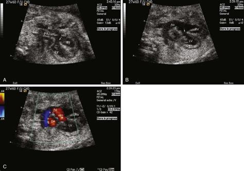 Double Outlet Right Ventricle Radiology Key