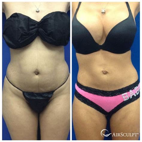 Pin On Airsculpt® Before And After Elite Body Sculpture