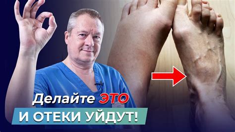 УСТАЛИ ОТ ОТЕКОВ? Узнайте, как быстро ИЗБАВИТЬСЯ ОТ ОТЕКОВ и улучшить ...