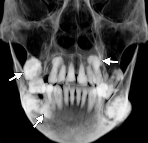 Radiopaque Jaw Lesions An Approach To The Differential Diagnosis