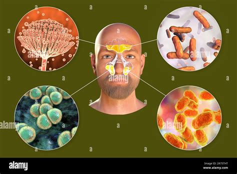 Rinosinusitis Y Microorganismos Que Causan Sinusitis Hongos