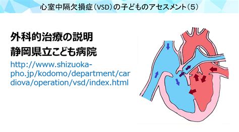 心室中隔欠損症（vsd）の子どものアセスメント｜カテ子ネット