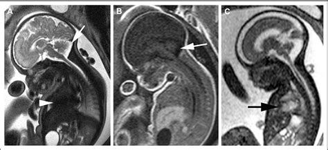 Figure From Fetal Magnetic Resonance Imaging Mri Semantic Scholar