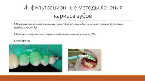 Кариес в стадии меловидного пятна - презентация онлайн