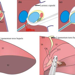 The TICGL Technique In Laparoscopic S2 Liver Resection A Anatomical