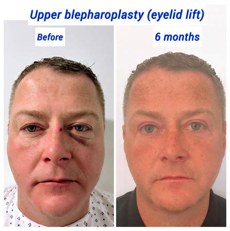 How Long Does Swelling Last After Eyelid Surgery Harley Clinic