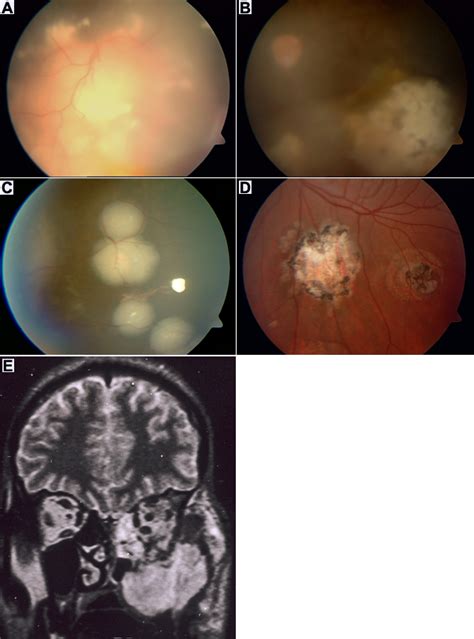 Head And Neck Retinoblastoma