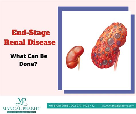 Causes, Symptoms and Treatments of End-Stage Renal Disease