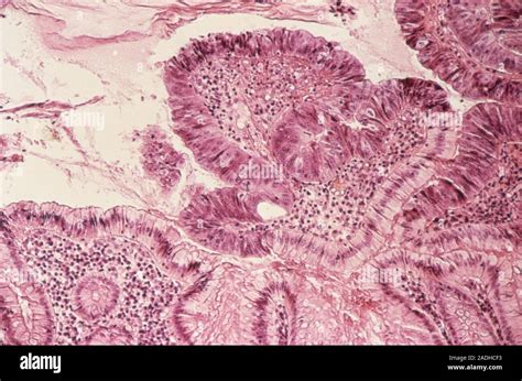 Colon Cancer Light Micrograph Of A Section Through An Adenocarcinoma