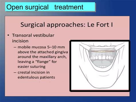 Mid Face Fracture Maxillary Fracture Ppt