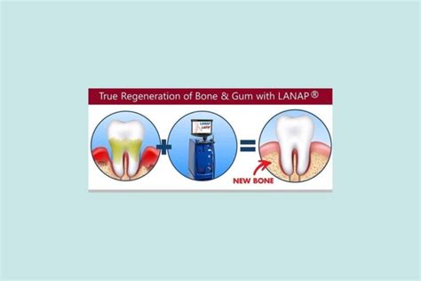 A Year After LANAP Laser Gum Surgery