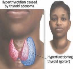 Thyroid Enlargment - Enlarged Thyroid