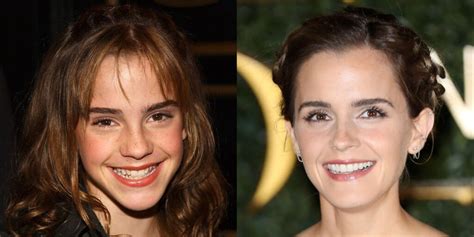 How Do Celebrities Fix Their Teeth So Fast? - Dental Image