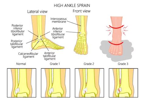 Ankle Sprain Treatment Symptoms And Prevention Mikkel Jarman