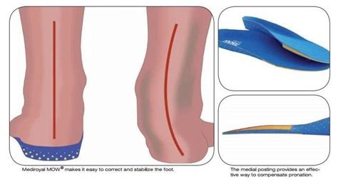 Medial Orthotic Wedge Insoles NOW Mediroyal