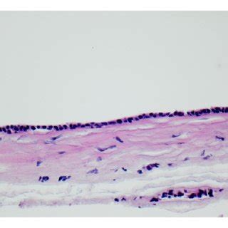 (PDF) Blue Ear Cyst: A Rare Eccrine Hidrocystoma of the Ear Canal and ...