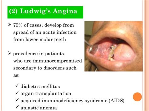 Odontogenic Infections 4