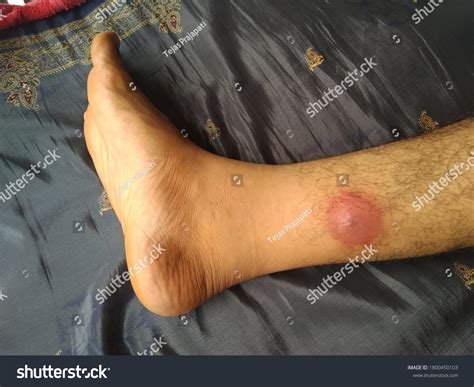 Boil Furuncle On Leg Painful Pus Filled Stock Photo 1800450103