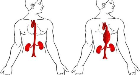 Aortic Aneurysm: Diagnosis and Treatment