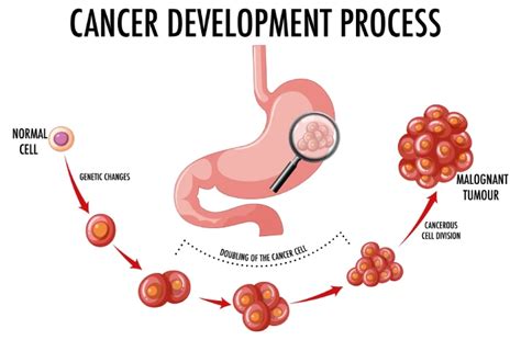 Stomach Cancer Symptoms Causes And New Treatments