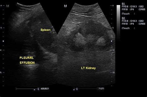 Bilateral Pleural Effusions With Ascites Image Radiopaedia Org