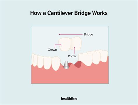 Cantilever Dental Bridge Pros And Cons At Gary Reames Blog