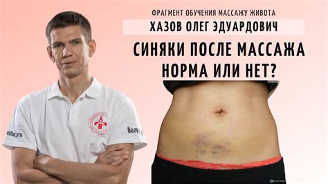Синяки после массажа. Норма или нет? Фрагмент обучения массажу живота ...