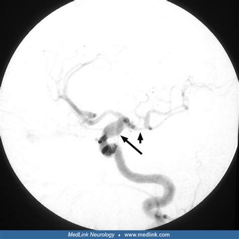 Fusiform And Dolichoectatic Aneurysms Medlink Neurology