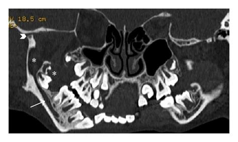 A Panoramic Dental Scan Depicting Enlarged Inferior Alveolar Canal Download Scientific