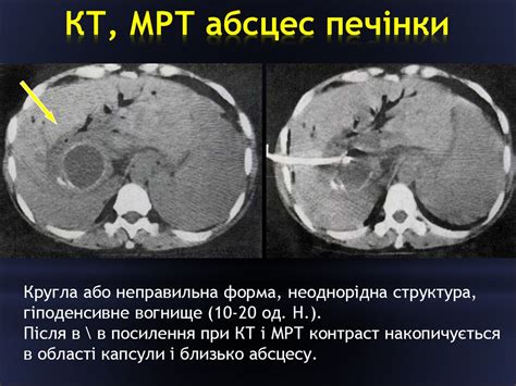 Променеве дослідження гепатопанкреатобіліарної системи і селезінки ...
