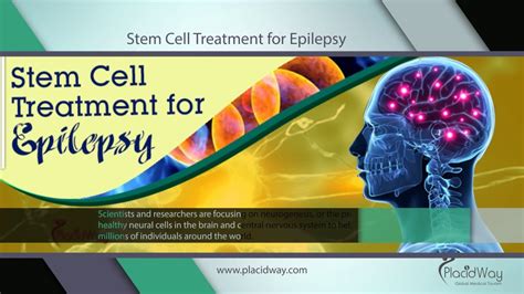 Epilepsy Treatment Stem Cell Therapy For Epilepsy Youtube