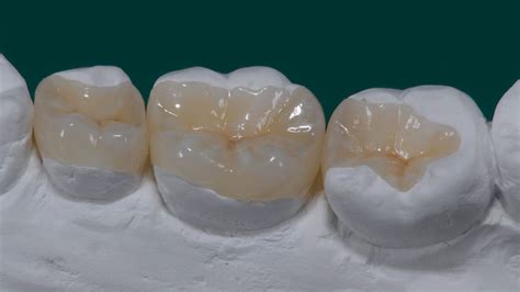 Porcelain inlay and onlay » Chic Dental