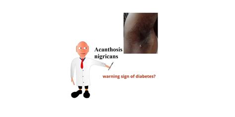 Acanthosis nigricans – a warning sign of diabetes?