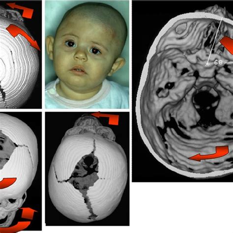 Dynamic Compensatory Changes Of The Skull And The Face Bone Complex