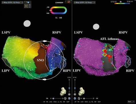 Electroanatomical Map Of The Left Atrium Of The Heart A Activation