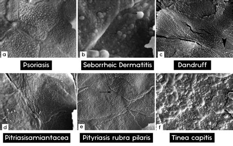 Dandruff Flakes Under Microscope: Symptoms, Causes and Treatment