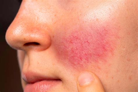 Rosacea Ursachen Symptome Behandlung Sanubiom